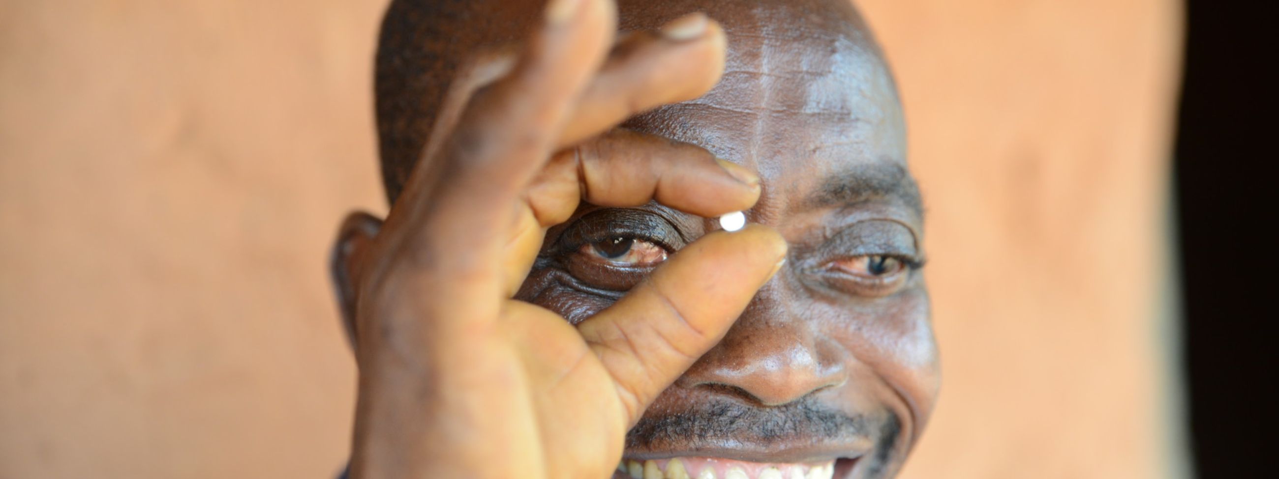 Vincent lost the eyesight of his left eye due to onchocerciasis - but Mectizan® saved the vision of his right eye.
