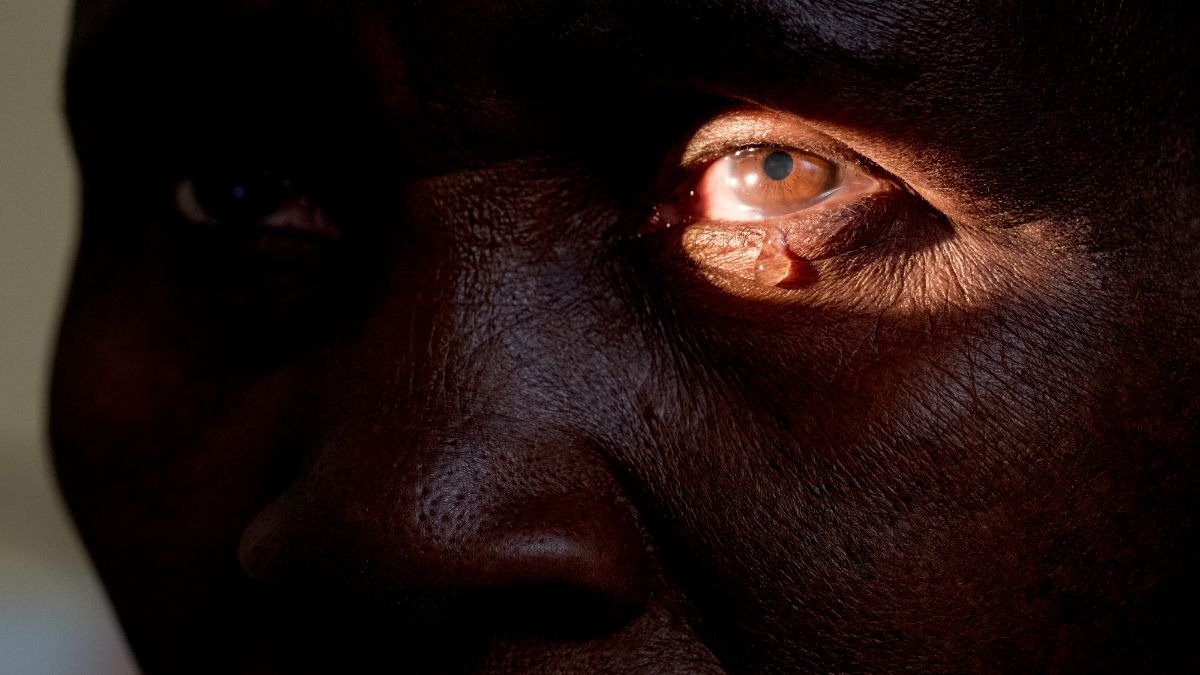 Aida Zakumbayo, pictured at the hospital before her surgery for bilateral trachoma trichiasis.