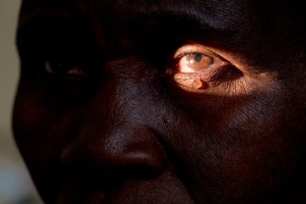 Aida Zakumbayo, pictured at the hospital before her surgery for bilateral trachoma trichiasis.