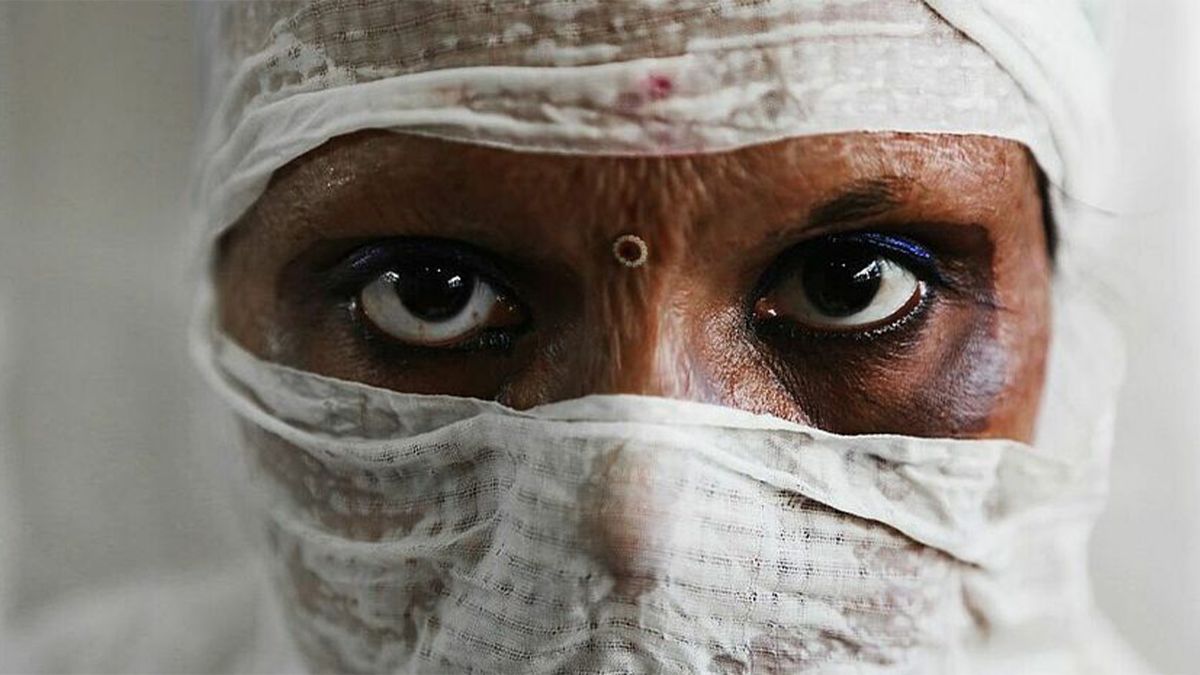 A victim of gender-based violence from India. She was attacked with acid by her husband.